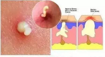 白头痘痘的最佳治疗方案